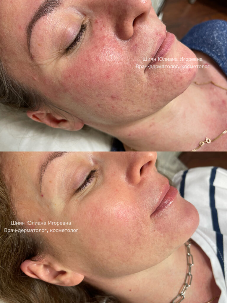 Rroзea ea (ruзwolathtы leheenemane y on-sowoTы-vraчa-dermatologa)
