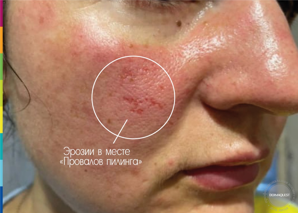 Dermaquest »kakraTath oshogi и krasnotutueposlegepkynga | 